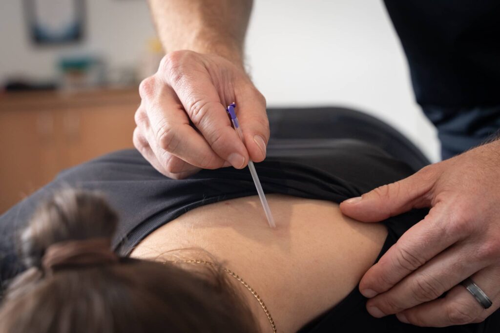 dry needling in upper back from chiropractor